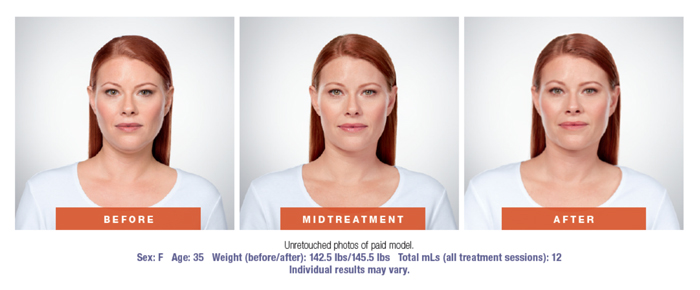 Kybella Before & After Results