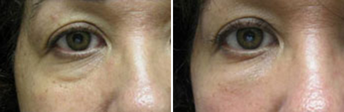 Facial Fillers Before & After Results in Rhode Island