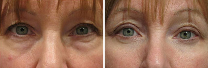 Eyelid Malpositions before and afters in Rhode Island