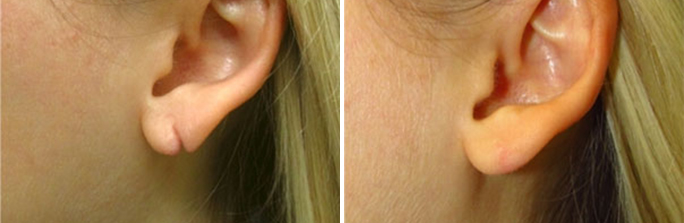 Earlobe repair before and after photos in Rhode Island by Dr. Enzer