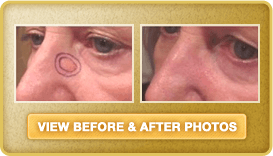 Skin Cancer Treatment