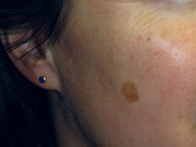 Brown Spot Removal before and after in Rhode Island