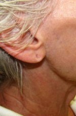 Earlobe Repair