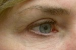 Eyelid and Upper Facial Surgery