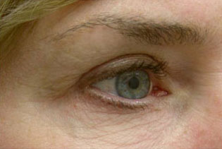 Eyelid Surgery before and after photos in Rhode Island