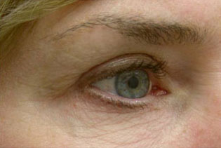 Eyelid and Upper Facial Surgery