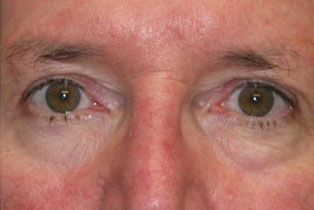 Eyelid and Upper Facial Surgery