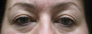 Eyelid and Upper Facial Surgery