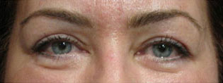 Eyelid and Upper Facial Surgery