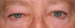 Eyelid and Upper Facial Surgery