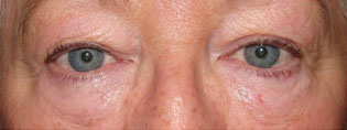 Eyelid and Upper Facial Surgery