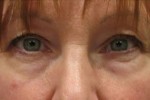 Eyelid and Upper Facial Surgery