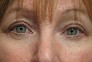 Eyelid and Upper Facial Surgery