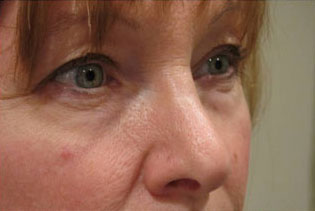 Eyelid and Upper Facial Surgery