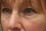 Eyelid and Upper Facial Surgery