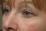 Eyelid and Upper Facial Surgery