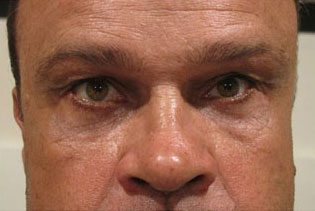 Eyelid and Upper Facial Surgery