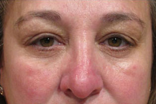 Eyelid and Upper Facial Surgery