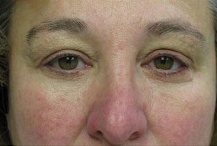 Eyelid and Upper Facial Surgery