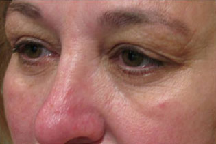 Eyelid and Upper Facial Surgery