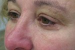 Eyelid and Upper Facial Surgery