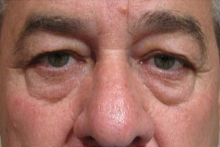 Eyelid and Upper Facial Surgery