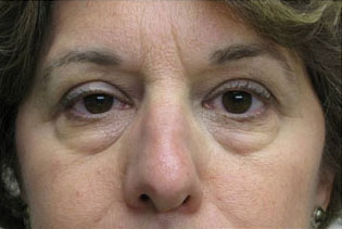 Eyelid and Upper Facial Surgery