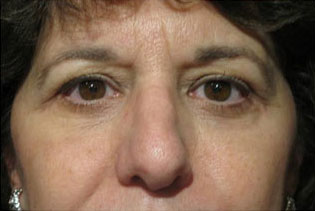 Eyelid and Upper Facial Surgery