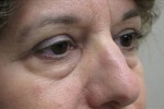 Eyelid and Upper Facial Surgery