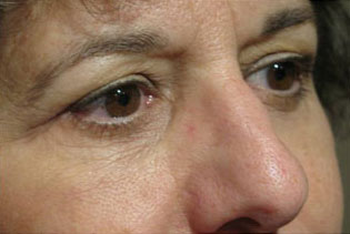 Eyelid and Upper Facial Surgery