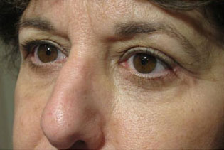 Eyelid and Upper Facial Surgery