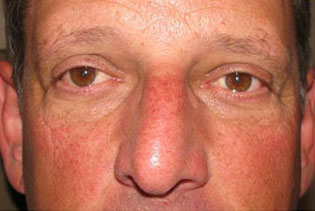 Eyelid and Upper Facial Surgery