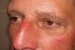 Eyelid and Upper Facial Surgery