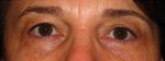 Eyelid and Upper Facial Surgery