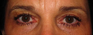 Eyelid and Upper Facial Surgery