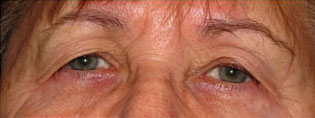 Eyelid and Upper Facial Surgery