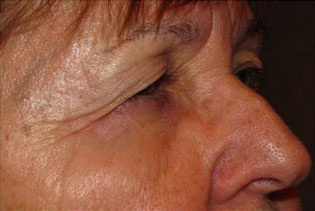 Eyelid and Upper Facial Surgery