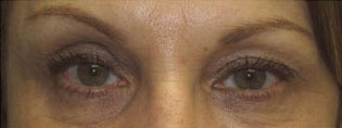 Eyelid and Upper Facial Surgery