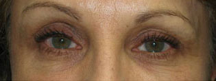 Eyelid and Upper Facial Surgery