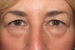 Eyelid and Upper Facial Surgery