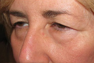 Eyelid and Upper Facial Surgery