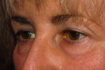 Eyelid and Upper Facial Surgery