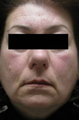 Facial fat transfer before and afters in Rhode Island by Dr. Enzer