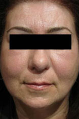 Facial fat transfer before and afters in Rhode Island by Dr. Enzer Facial fat transfer before and afters in Rhode Island by Dr. Enzer