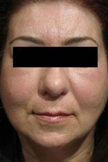 Facial fat transfer before and afters in Rhode Island by Dr. Enzer