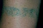 Laser Tattoo Removal