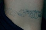 Laser Tattoo Removal