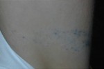 Laser Tattoo Removal