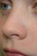 Laser to Remove Brown Spots