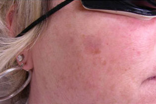 Laser to Remove Brown Spots